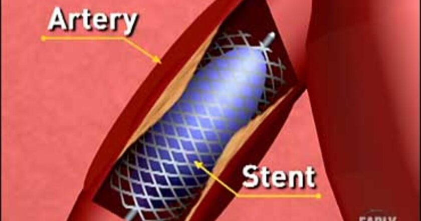 stent