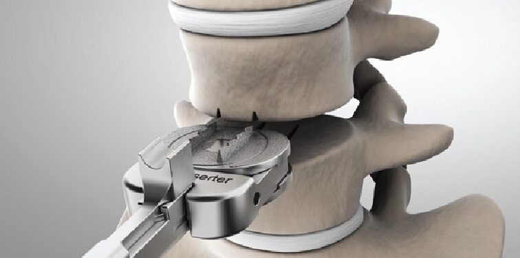 Artificial Cervical Disc